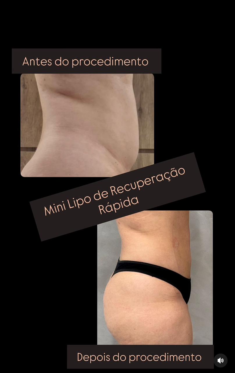 Resultado Mini Lipo - Antes e Depois